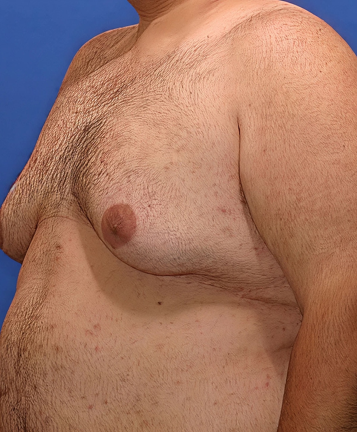 Side view of torso with chest hair.
