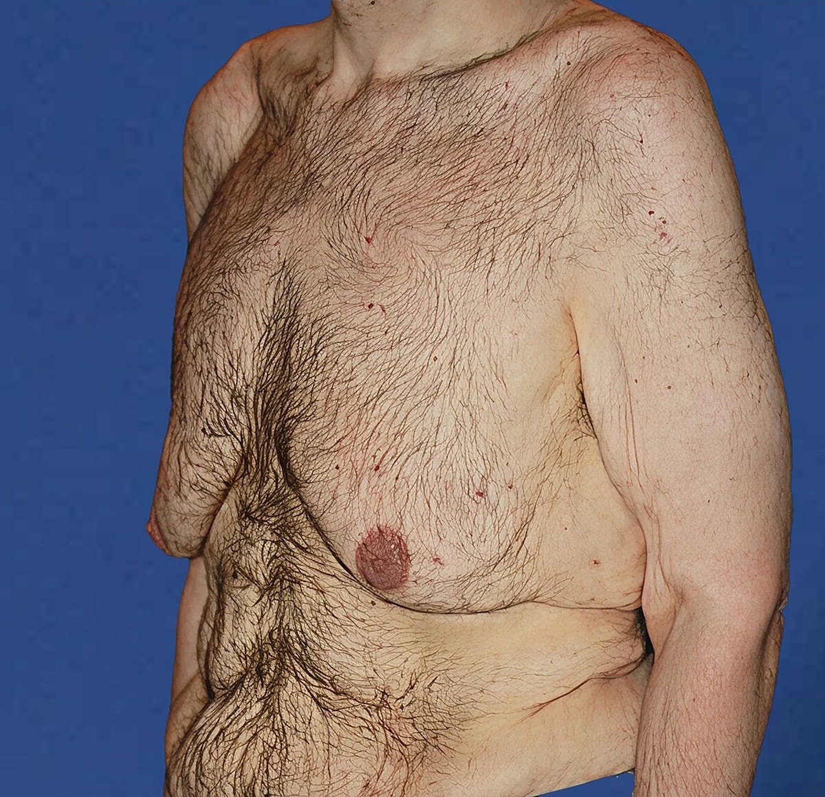 Bare male torso with body hair and markings.