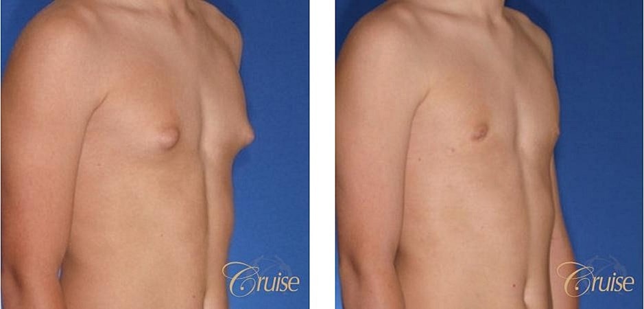Type 1 Gynecomastia Before & After