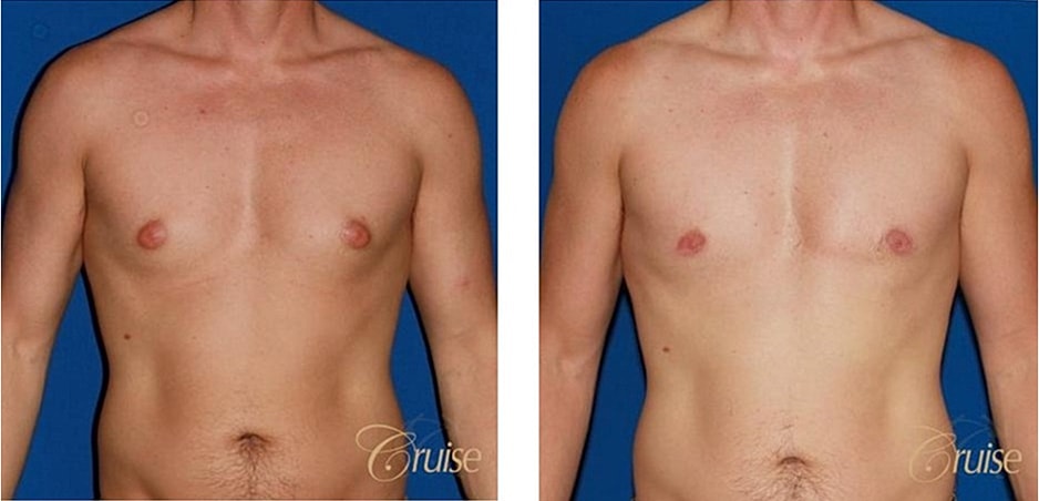 Type 1 Gynecomastia Before & After
