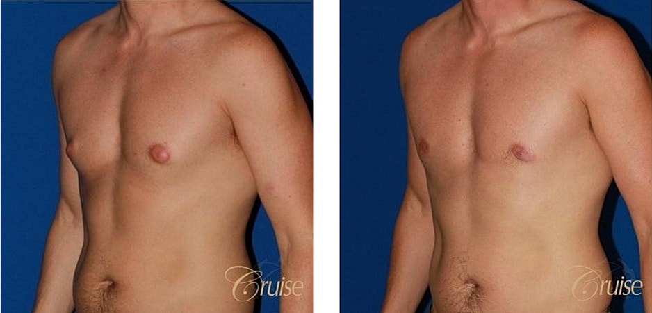 Type 1 Gynecomastia Before & After