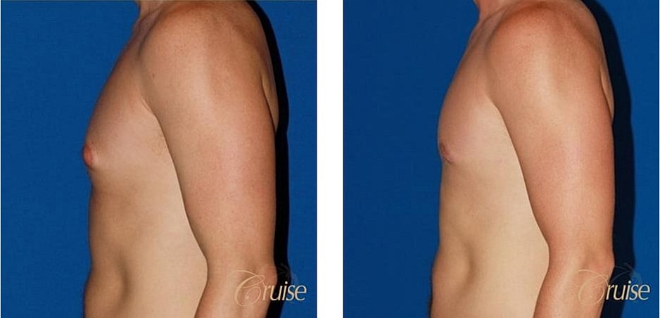 Type 1 Gynecomastia Before & After