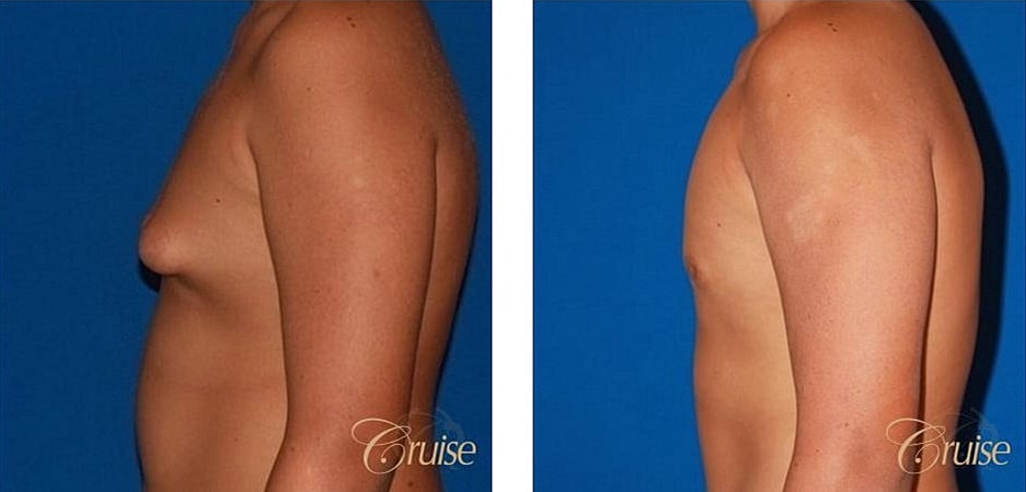 Type 1 Gynecomastia Before & After