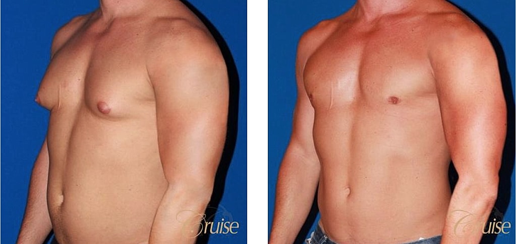 Bodybuilder Gynecomastia Before & After