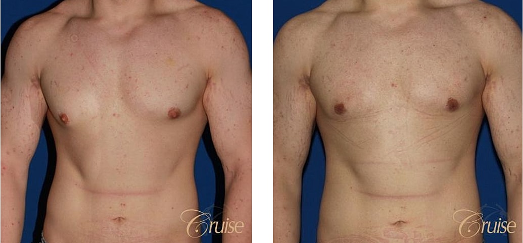 Bodybuilder Gynecomastia Before & After