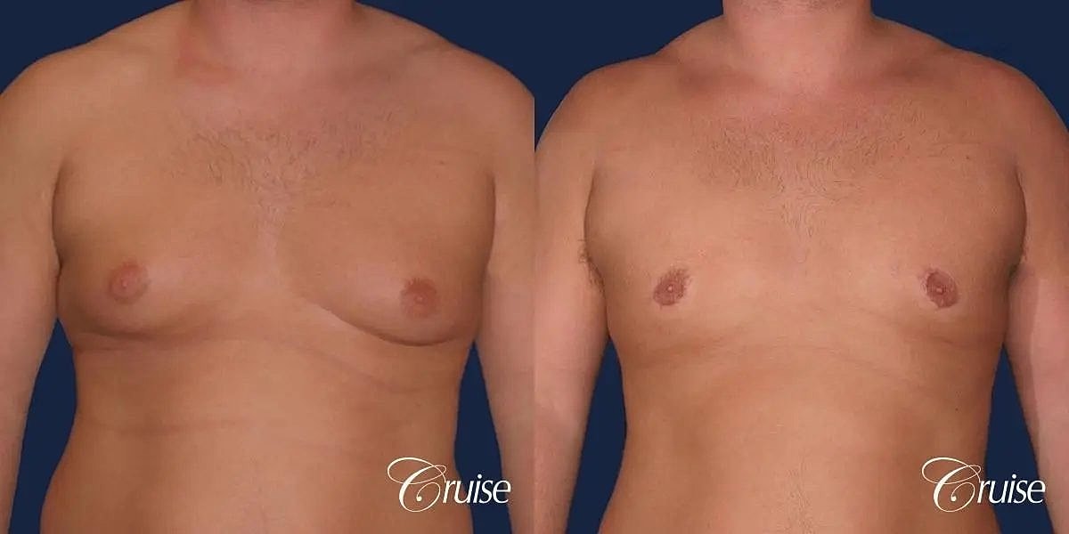 Gynecomastia Before & After