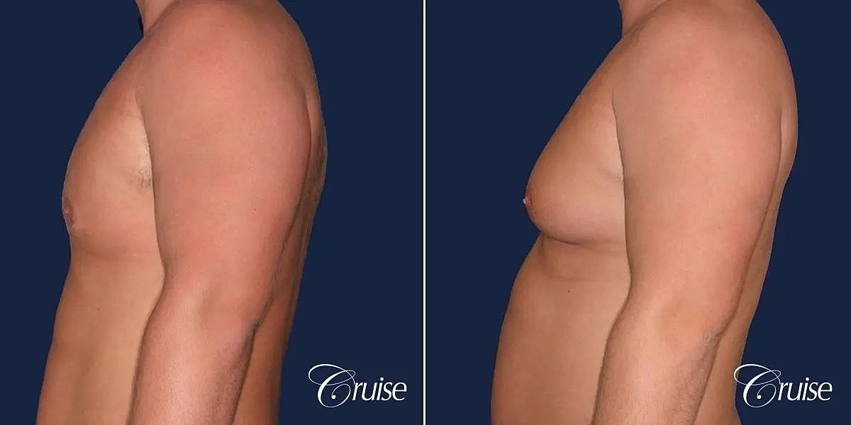 Gynecomastia Before & After