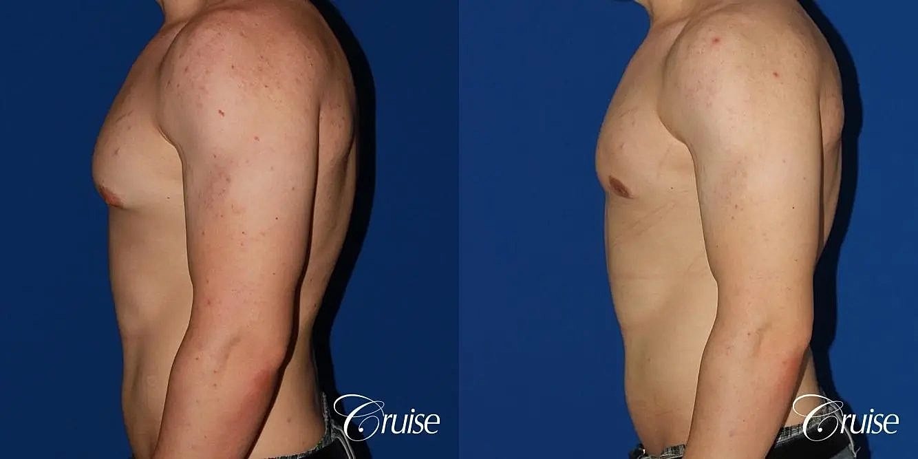 Gynecomastia Before & After