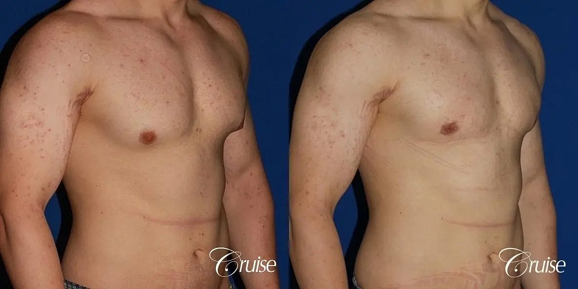 Gynecomastia Before & After