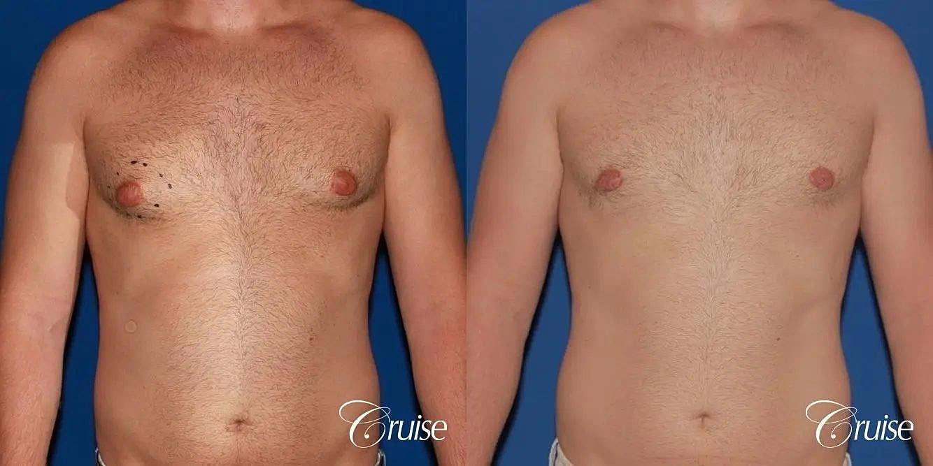 Gynecomastia Before & After