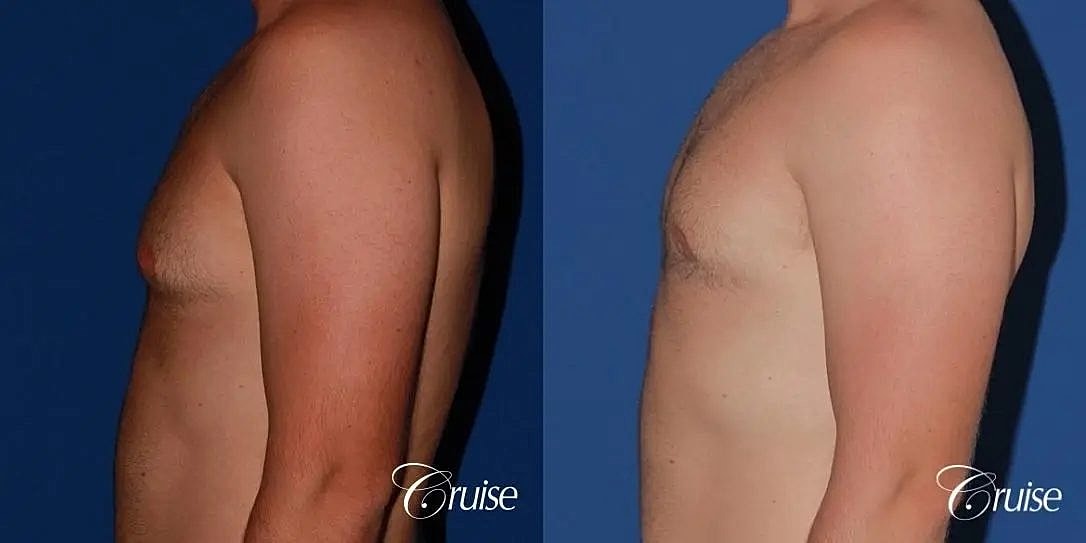 Gynecomastia Before & After
