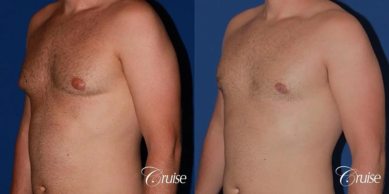 Gynecomastia Before & After