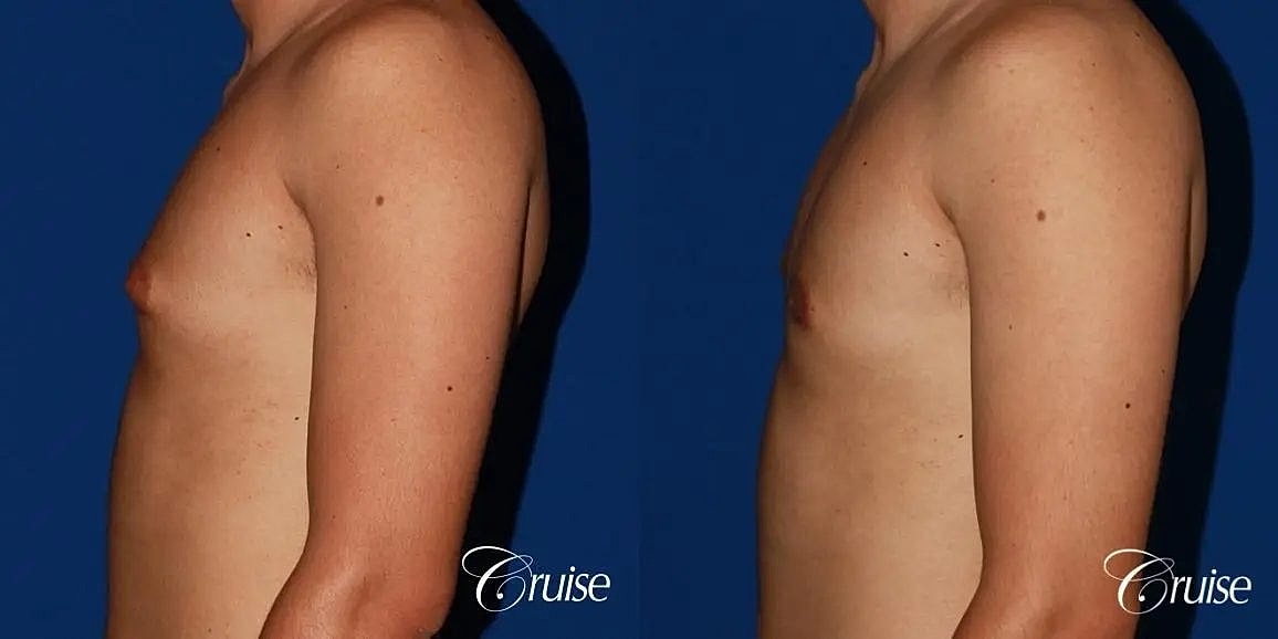 Gynecomastia Before & After