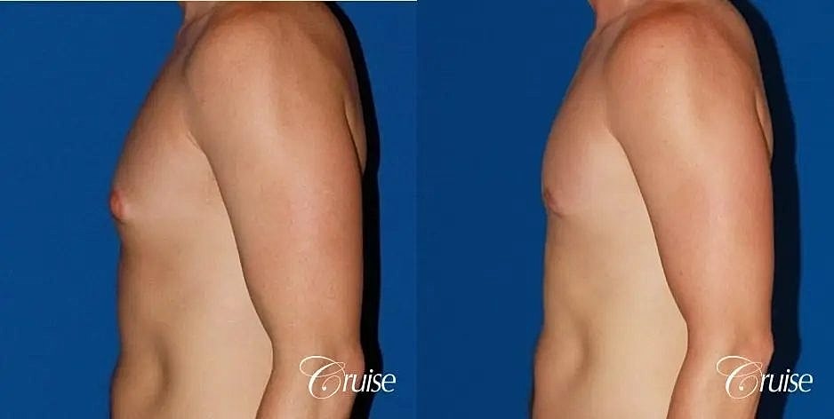 Gynecomastia Before & After