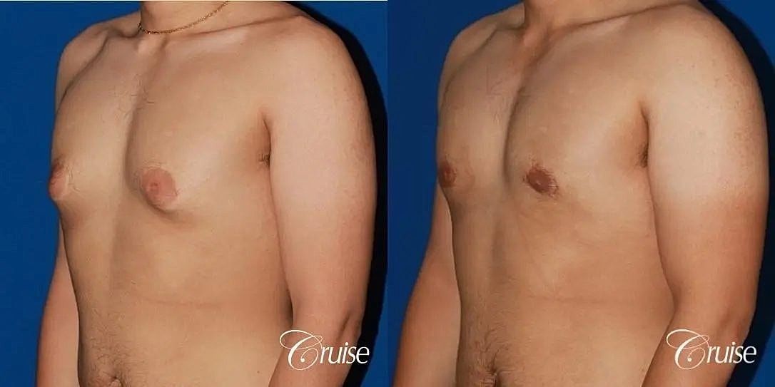 Gynecomastia Before & After