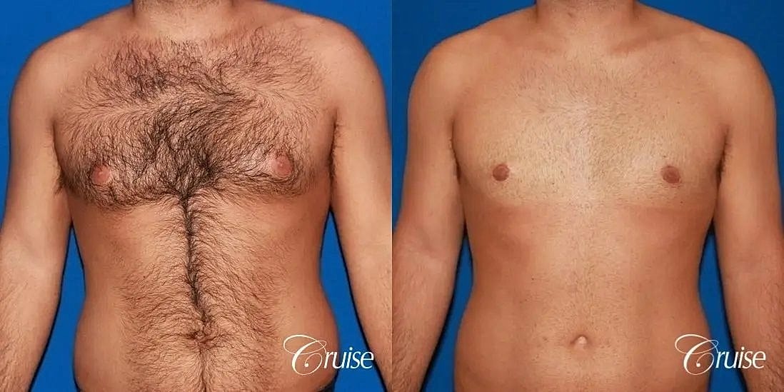 Gynecomastia Before & After