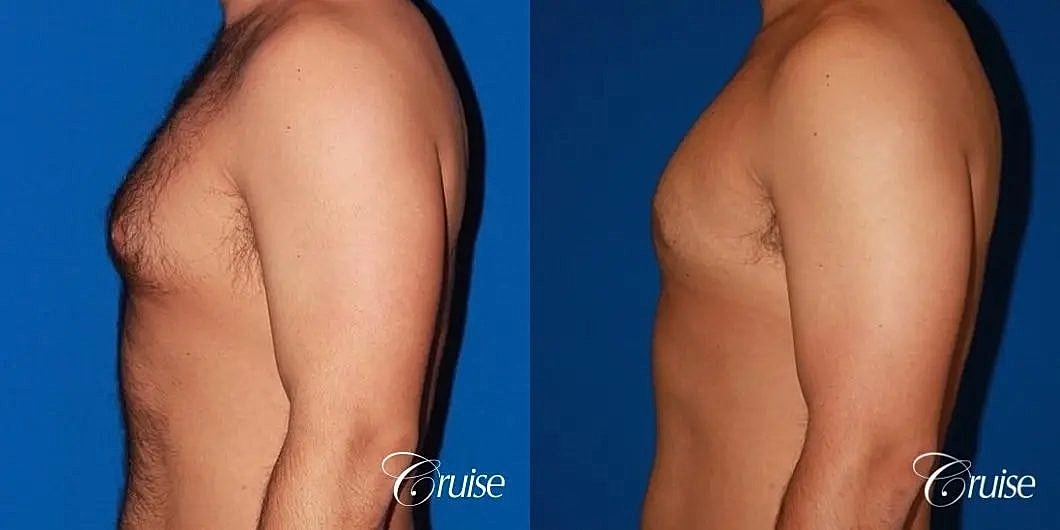 Gynecomastia Before & After