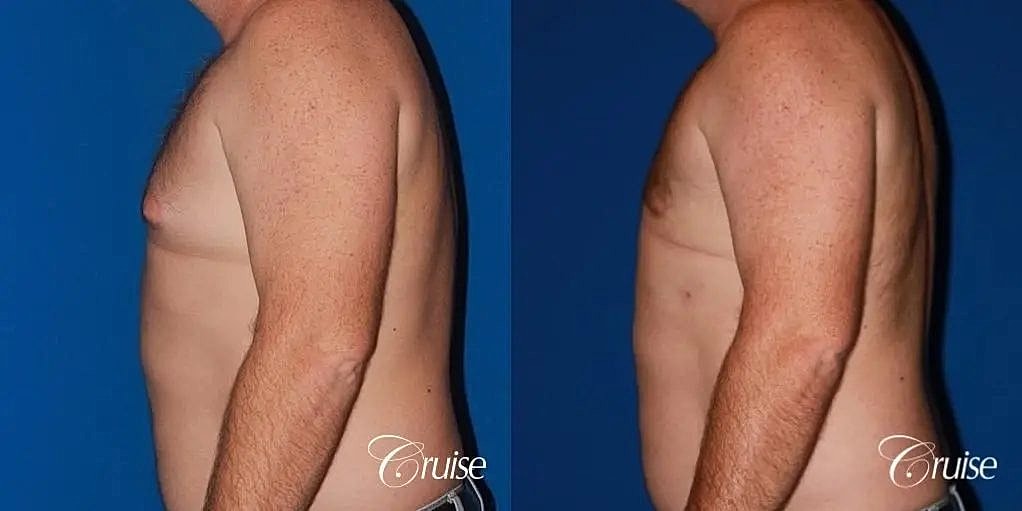 Gynecomastia Before & After