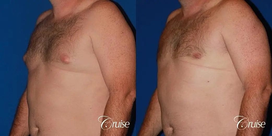 Gynecomastia Before & After