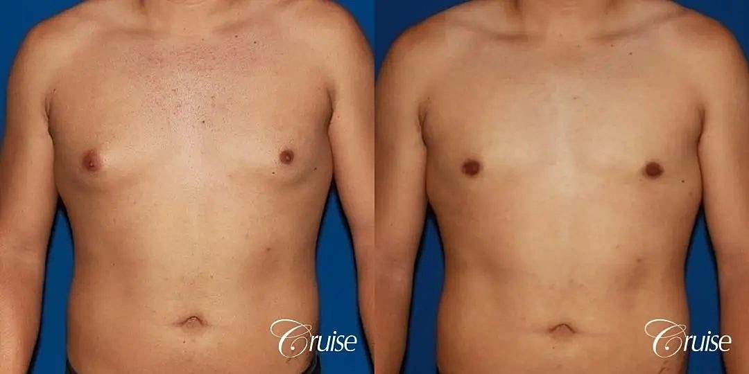 Gynecomastia Before & After