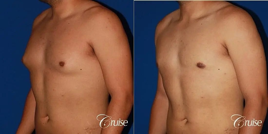 Gynecomastia Before & After