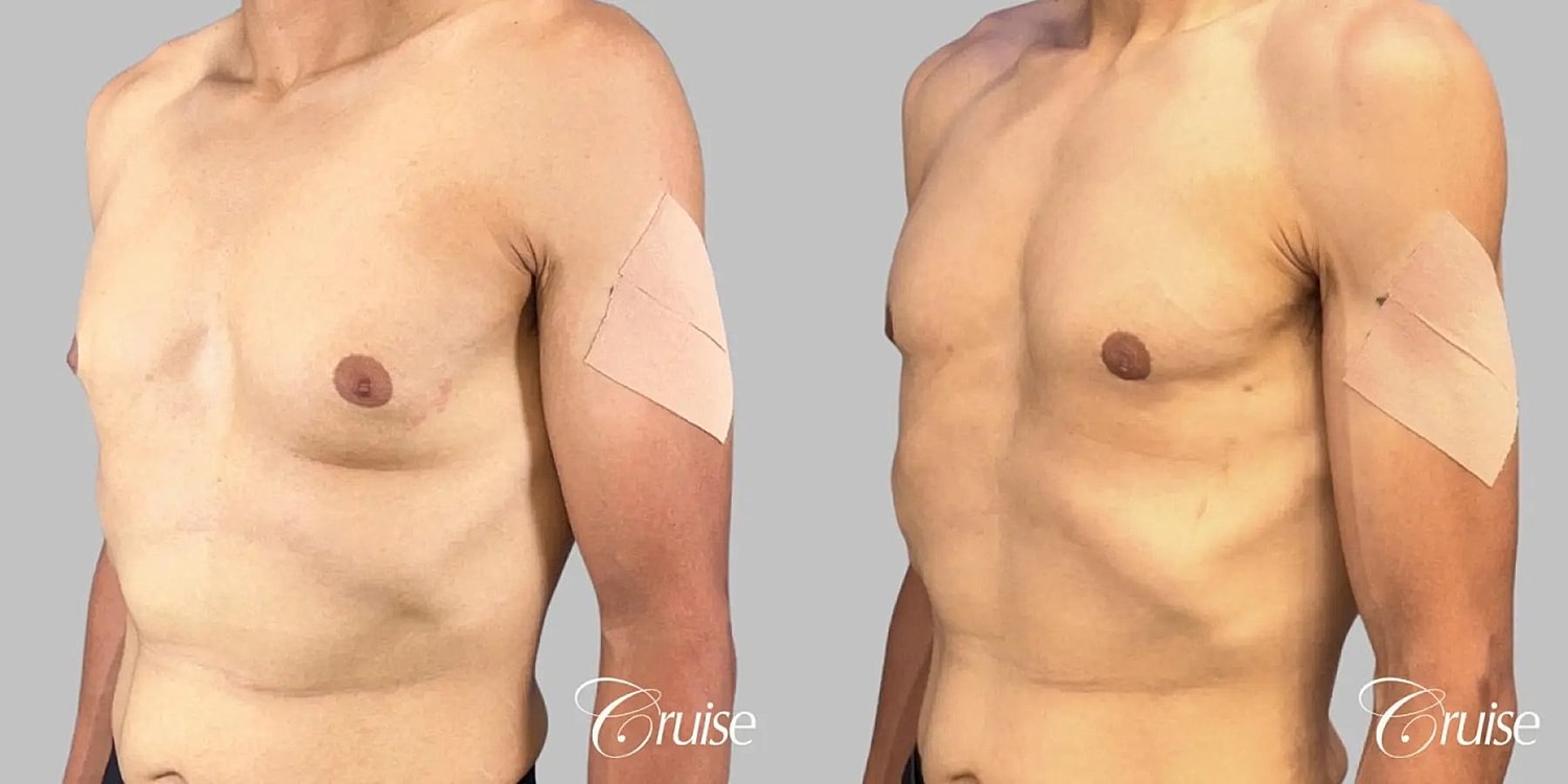 Gynecomastia Before & After
