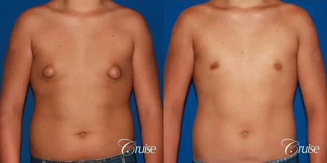 Gynecomastia Before & After