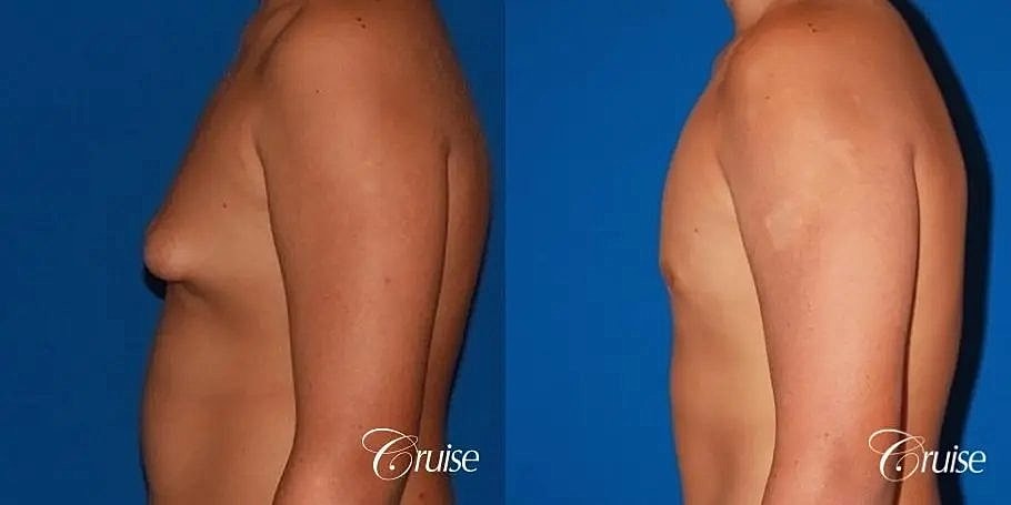 Gynecomastia Before & After