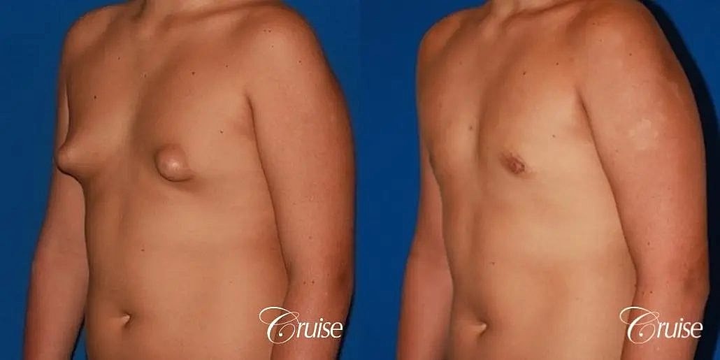 Gynecomastia Before & After