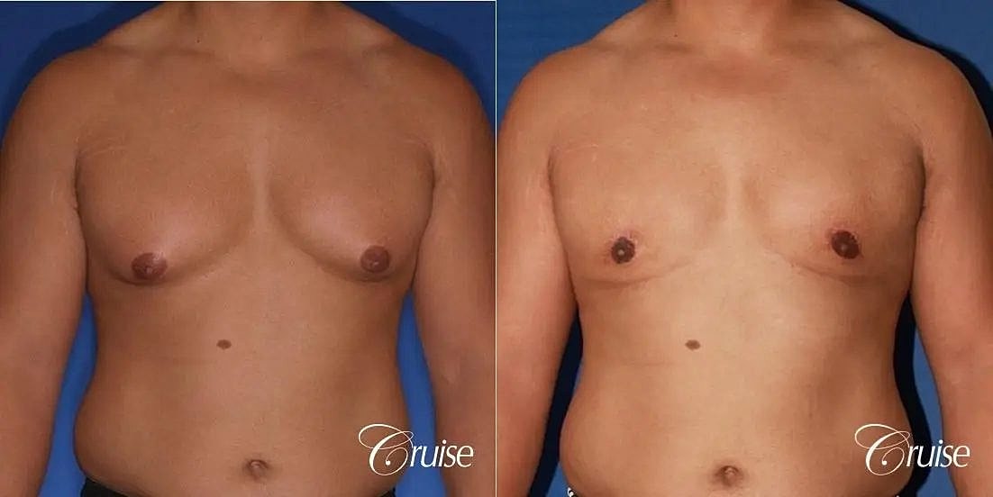Gynecomastia Before & After