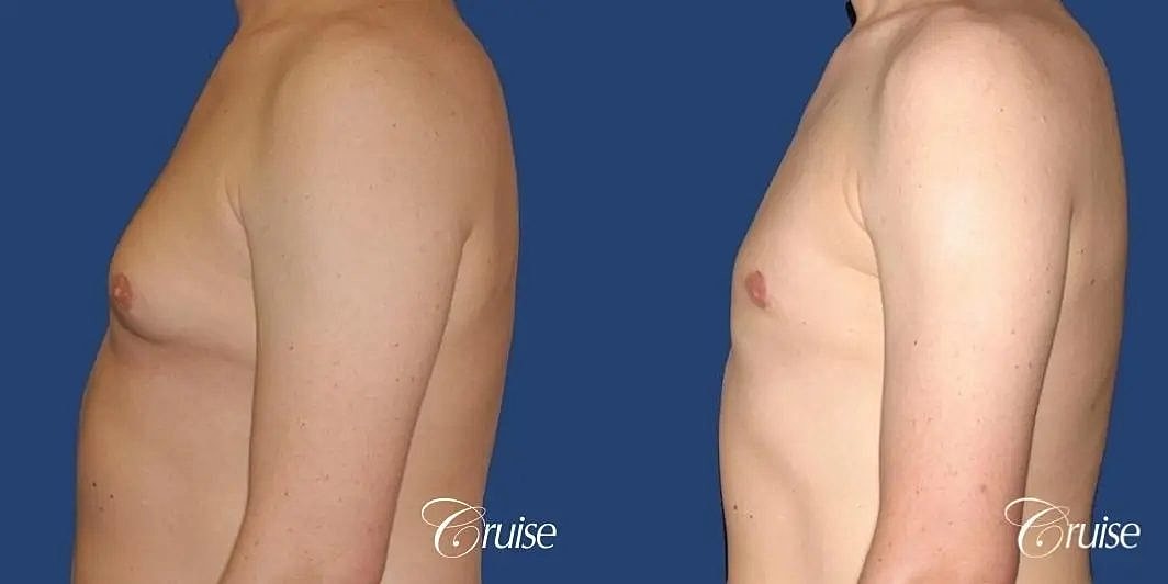 Gynecomastia Before & After