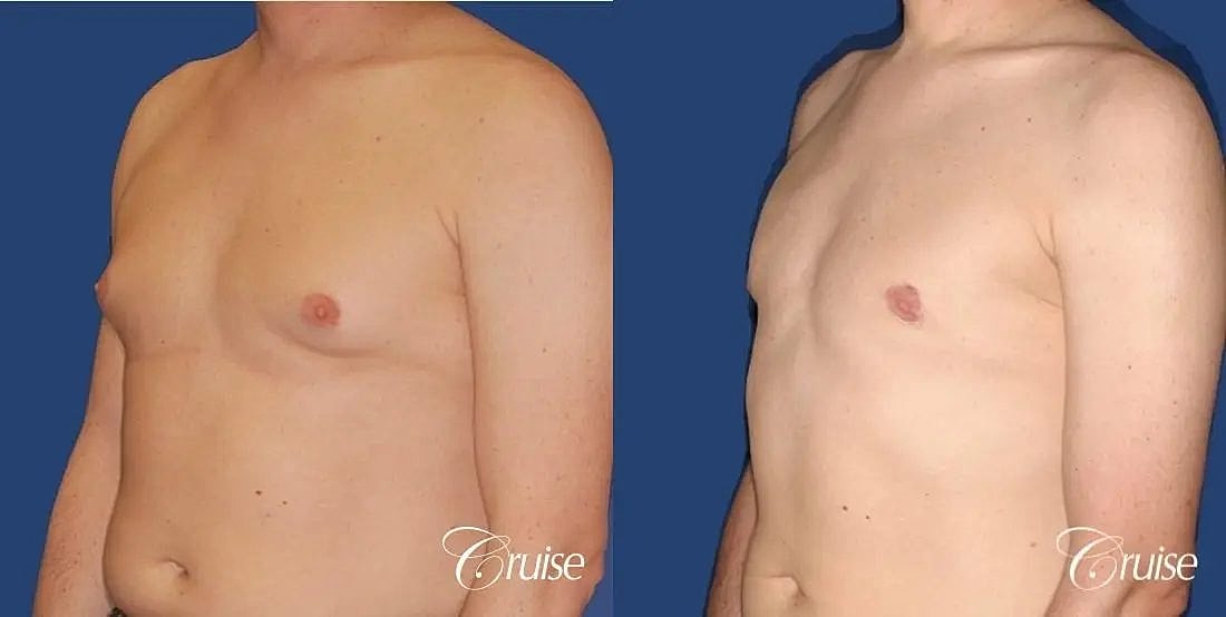 Gynecomastia Before & After