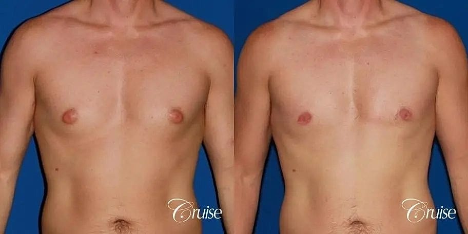 Gynecomastia Before & After