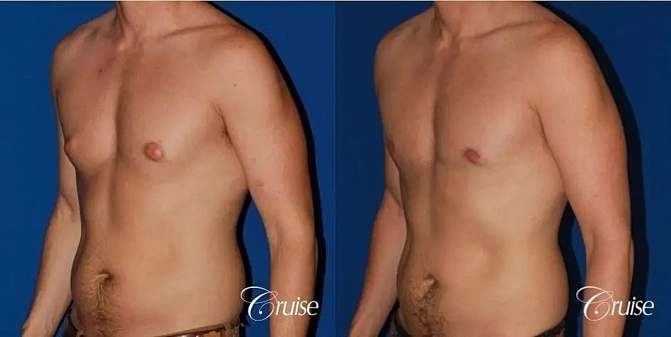 Gynecomastia Before & After