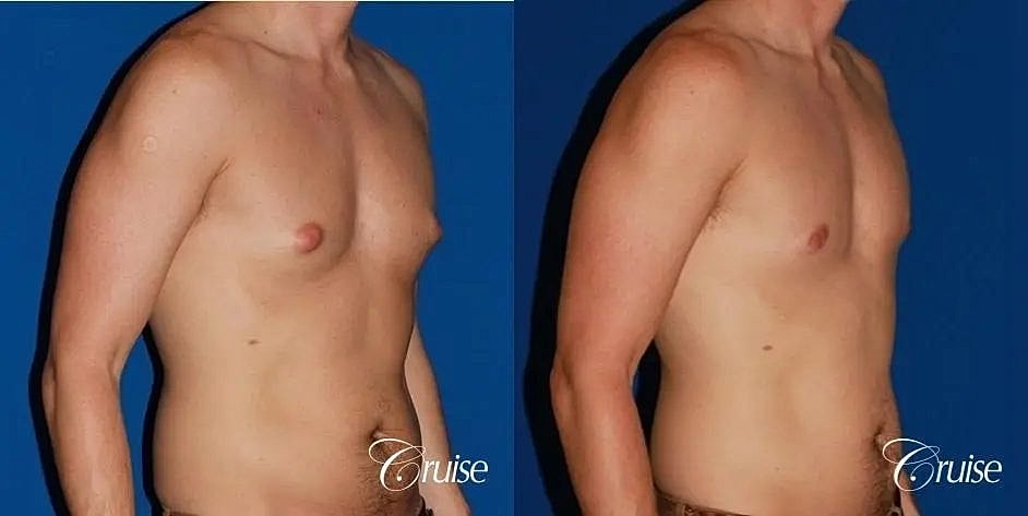 Gynecomastia Before & After