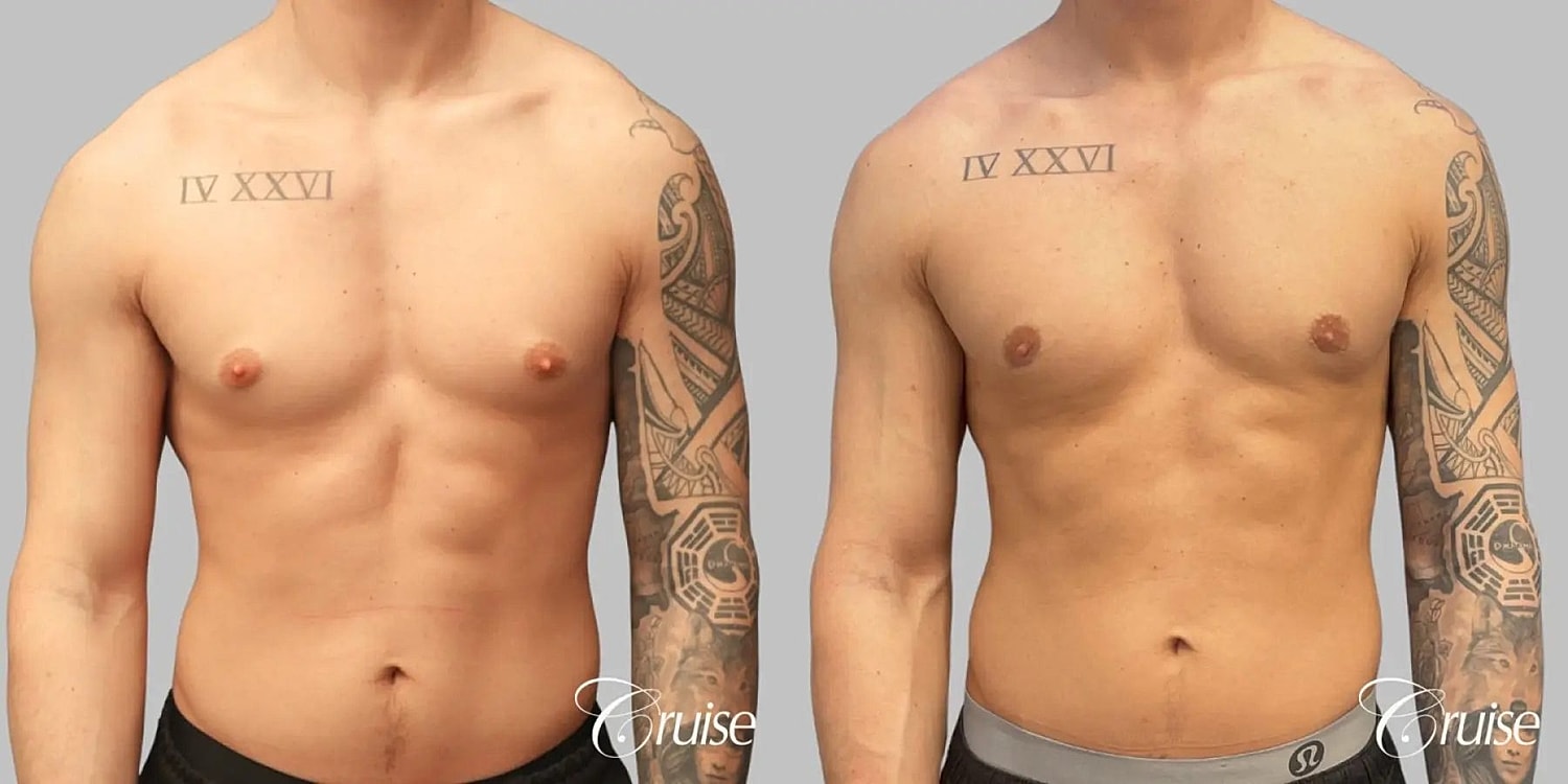 Gynecomastia Before & After