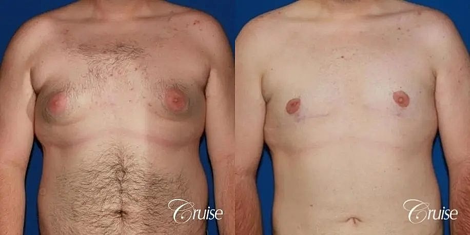 Gynecomastia Before & After