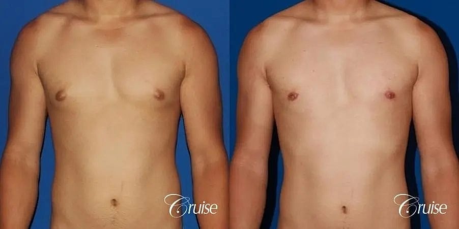 Gynecomastia Before & After