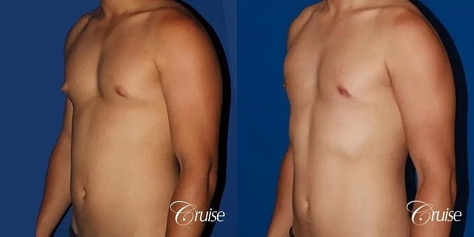 Gynecomastia Before & After