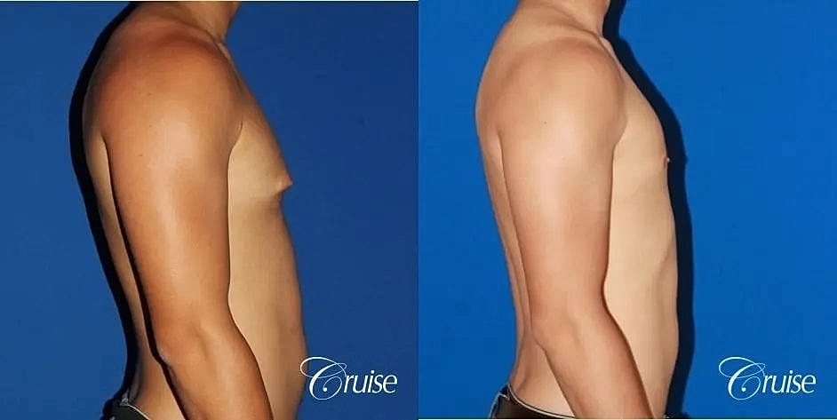 Gynecomastia Before & After
