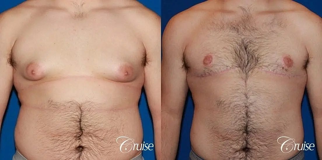 Gynecomastia Before & After