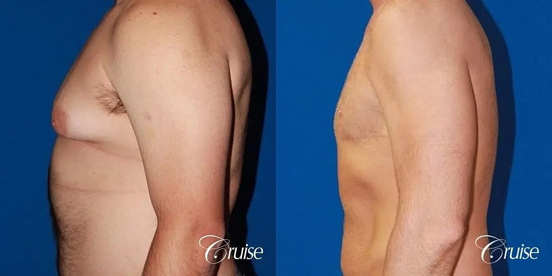 Gynecomastia Before & After