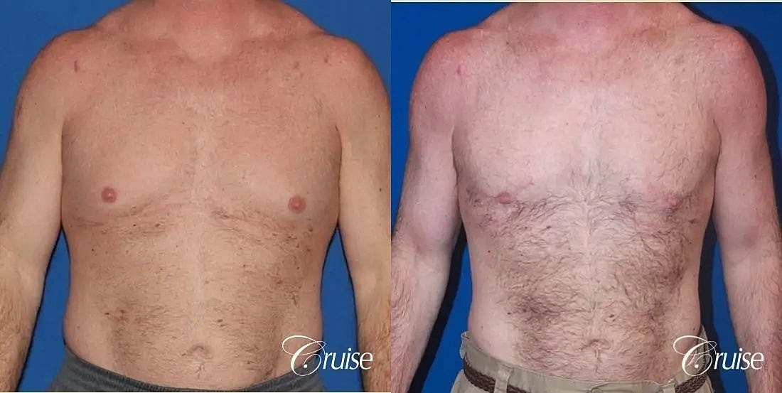 Gynecomastia Before & After