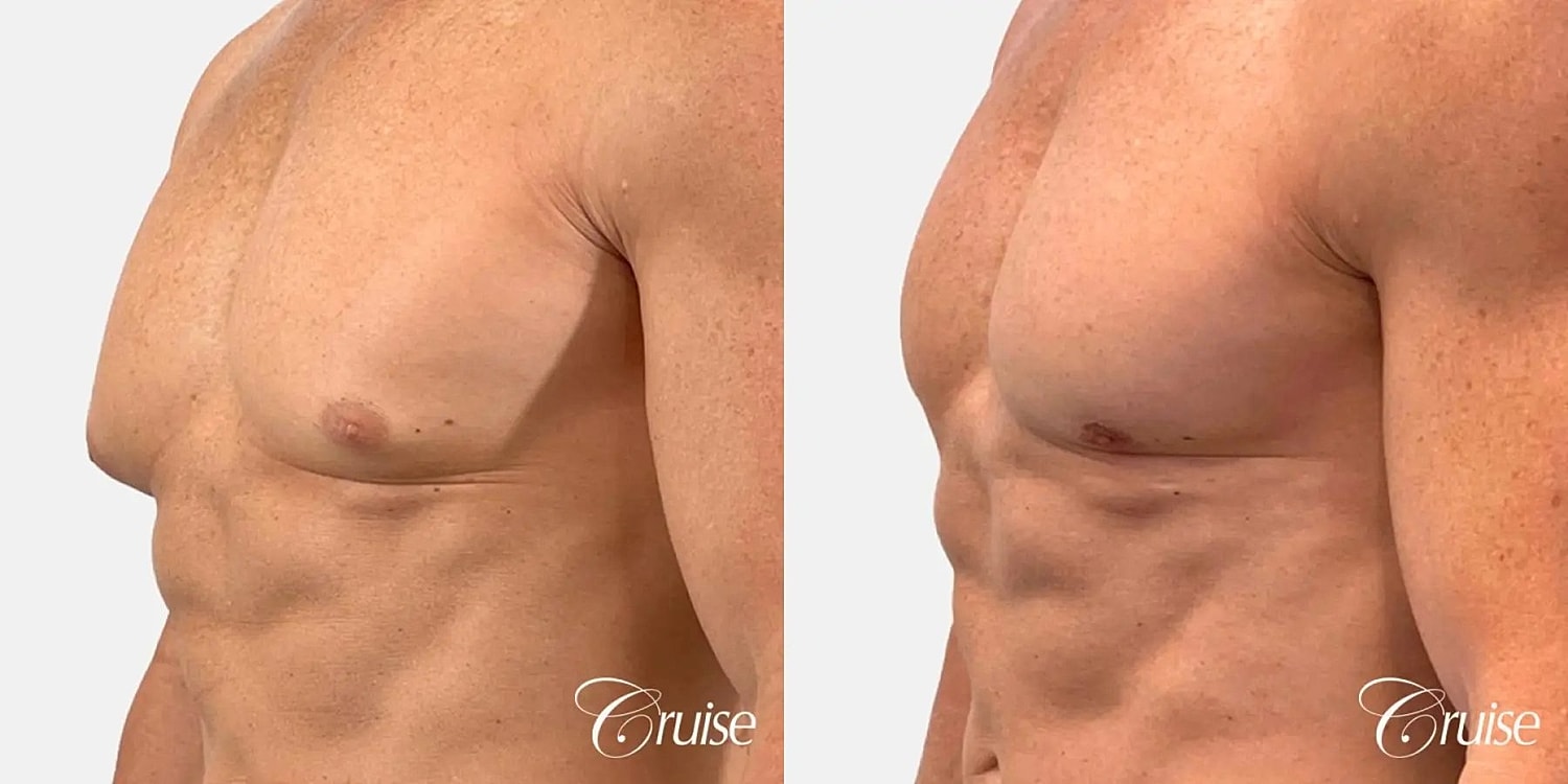 Gynecomastia Before & After