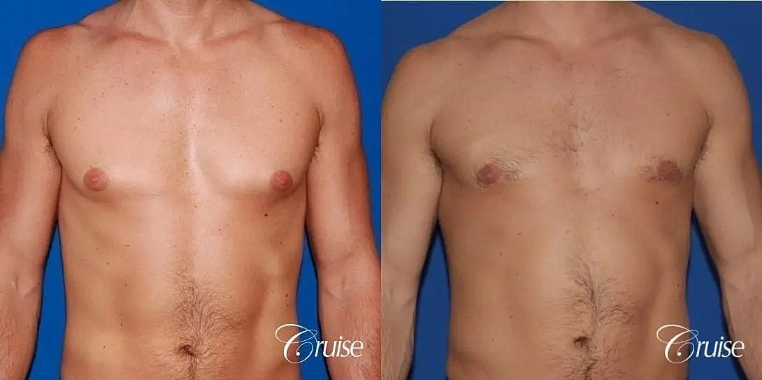 Gynecomastia Before & After