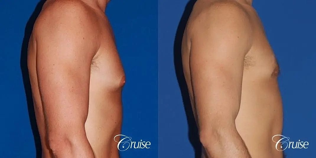 Gynecomastia Before & After