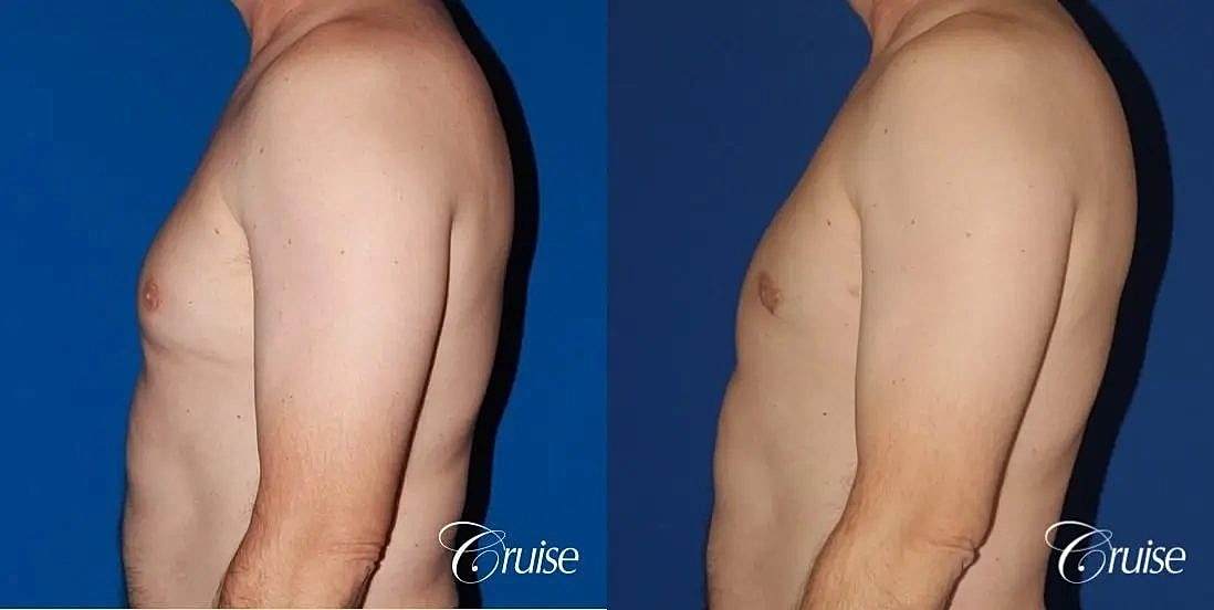 Gynecomastia Before & After