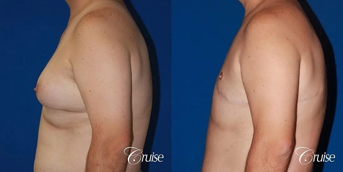 Gynecomastia Before & After