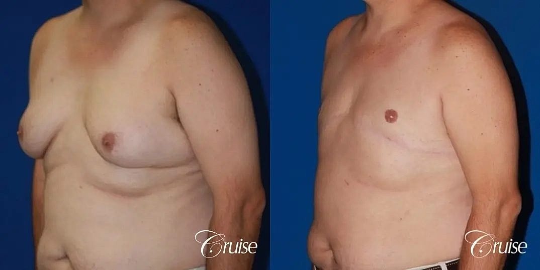 Gynecomastia Before & After