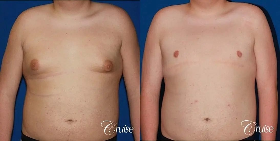 Gynecomastia Before & After